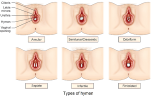 Illustration of different types of hymen